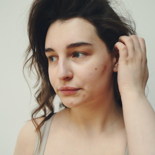 можно ли алкоголь при псориазе