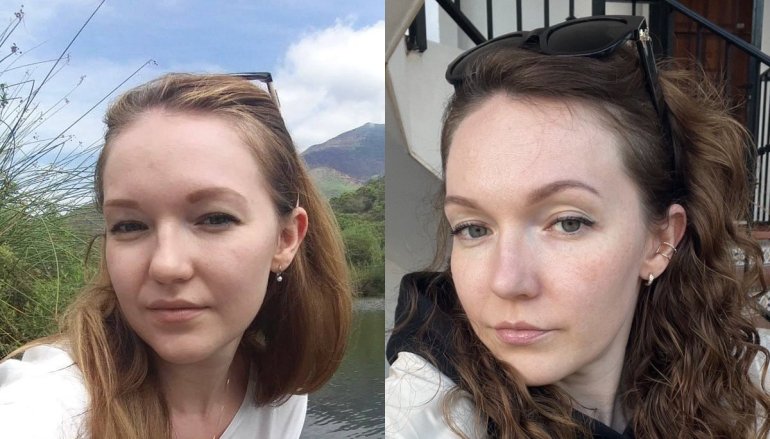 Ліворуч&nbsp;— моя шкіра з&nbsp;акне під шарами тонального крему до&nbsp;відмови від цукру. Праворуч&nbsp;— моя шкіра взагалі без тонального крему, чиста й&nbsp;підтягнута (фото в&nbsp;денному світлі, без фільтрів)